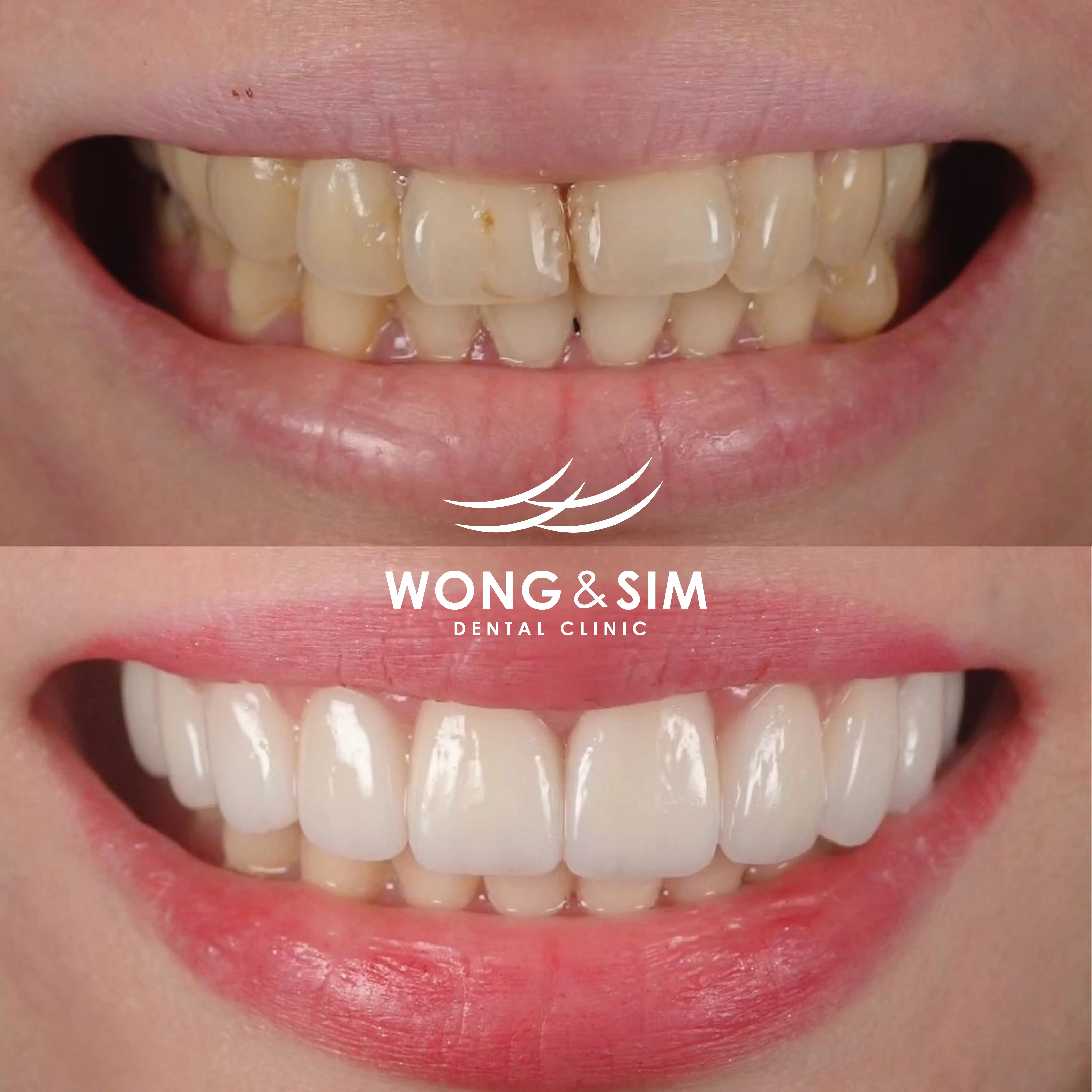 Patient 12 - Braces Before and After